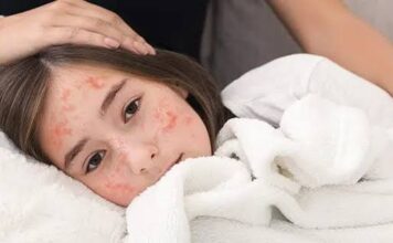 DPRD Ingatkan Bahaya Campak, Vaksinasi Anak Jadi Kunci Pencegahan